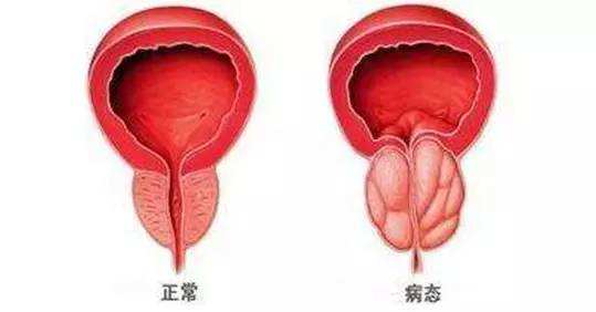 前列腺增生伴鈣化