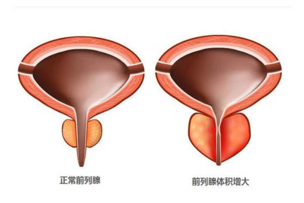 年輕人前列腺增大是什么原因