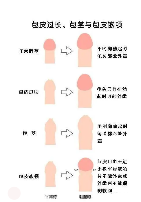 包皮過長是什么樣子